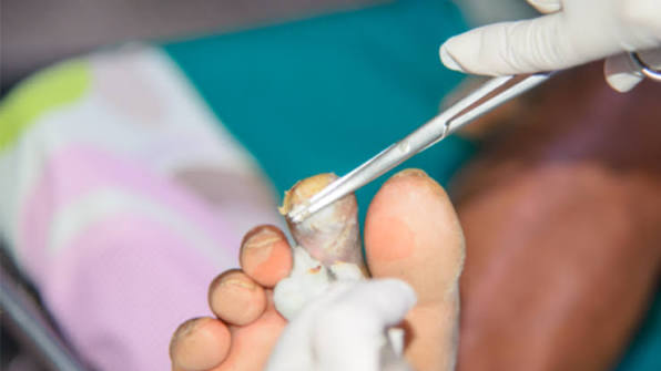 Wound Debridement & Dressing - Velura Clinic